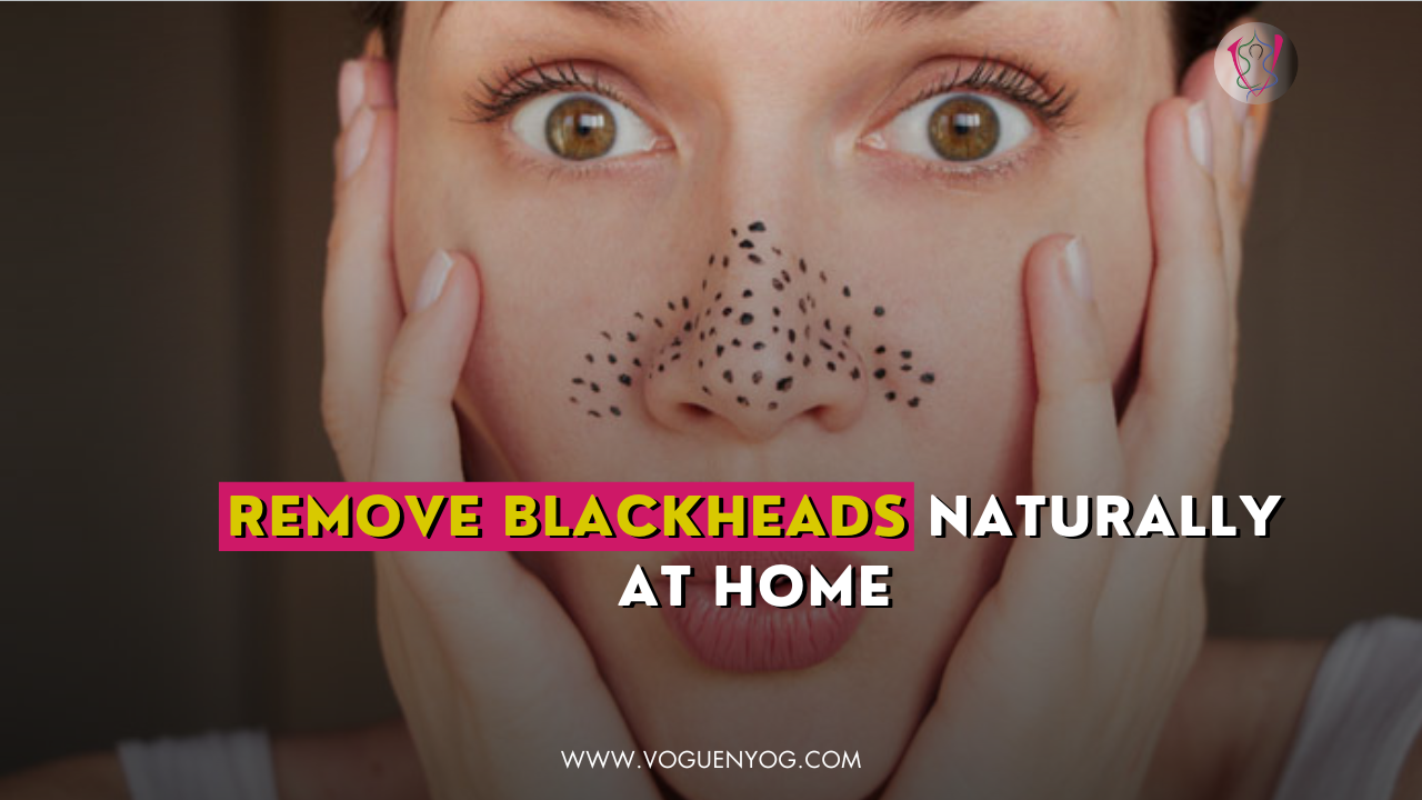 Blackheads Remove Blackheads Naturally At Home Voguenyog