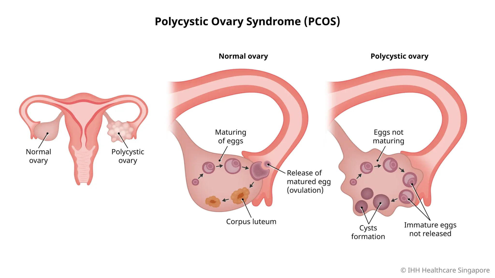 Polycystic Ovary Syndrome (PCOS) - Causes, Symptoms & Signs